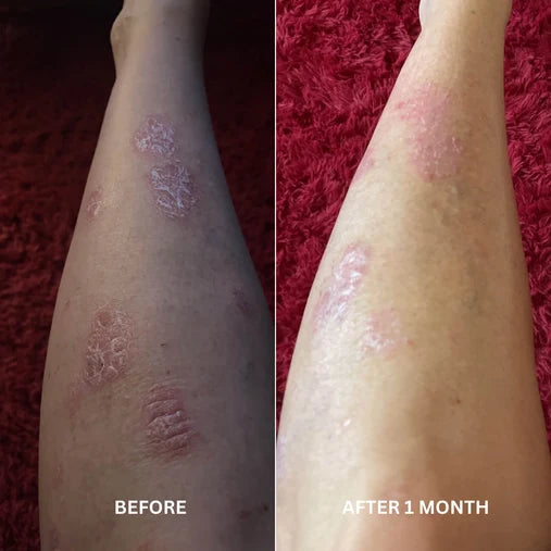 Before and after comparison of psoriasis improvement