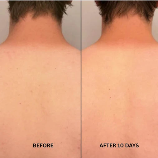 Before and after comparison of back irritation