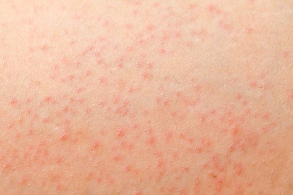 Close view of blemished skin