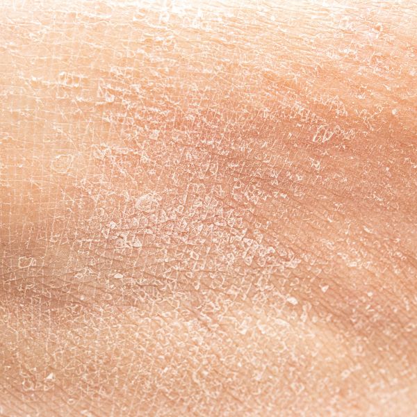 Close view of dry skin texture