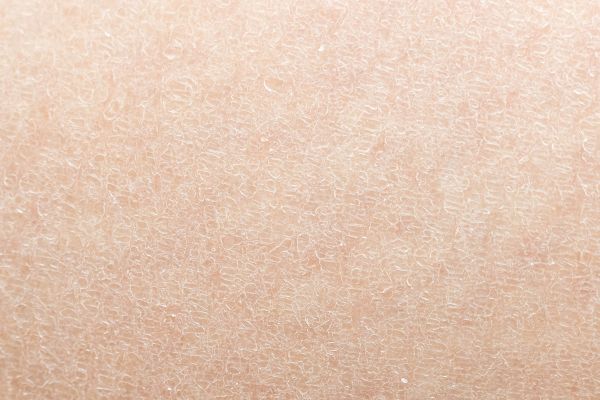 Close view of dull skin texture