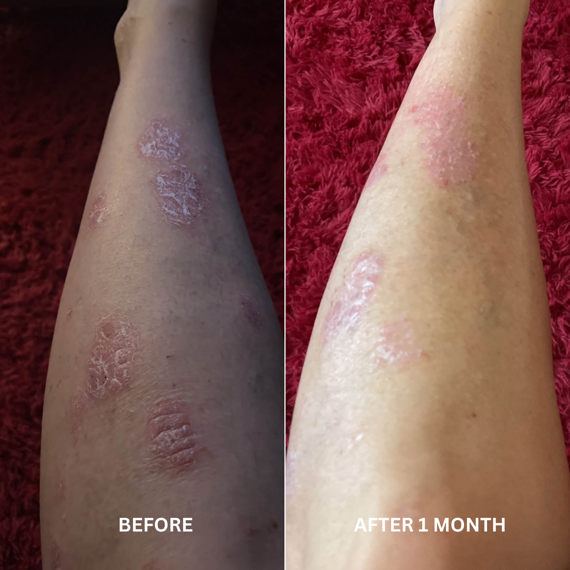 Before and after comparison of psoriasis improvement